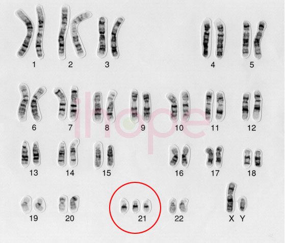 Tam bội nhiễm sắc thể 21 gây ra hội chứng Down