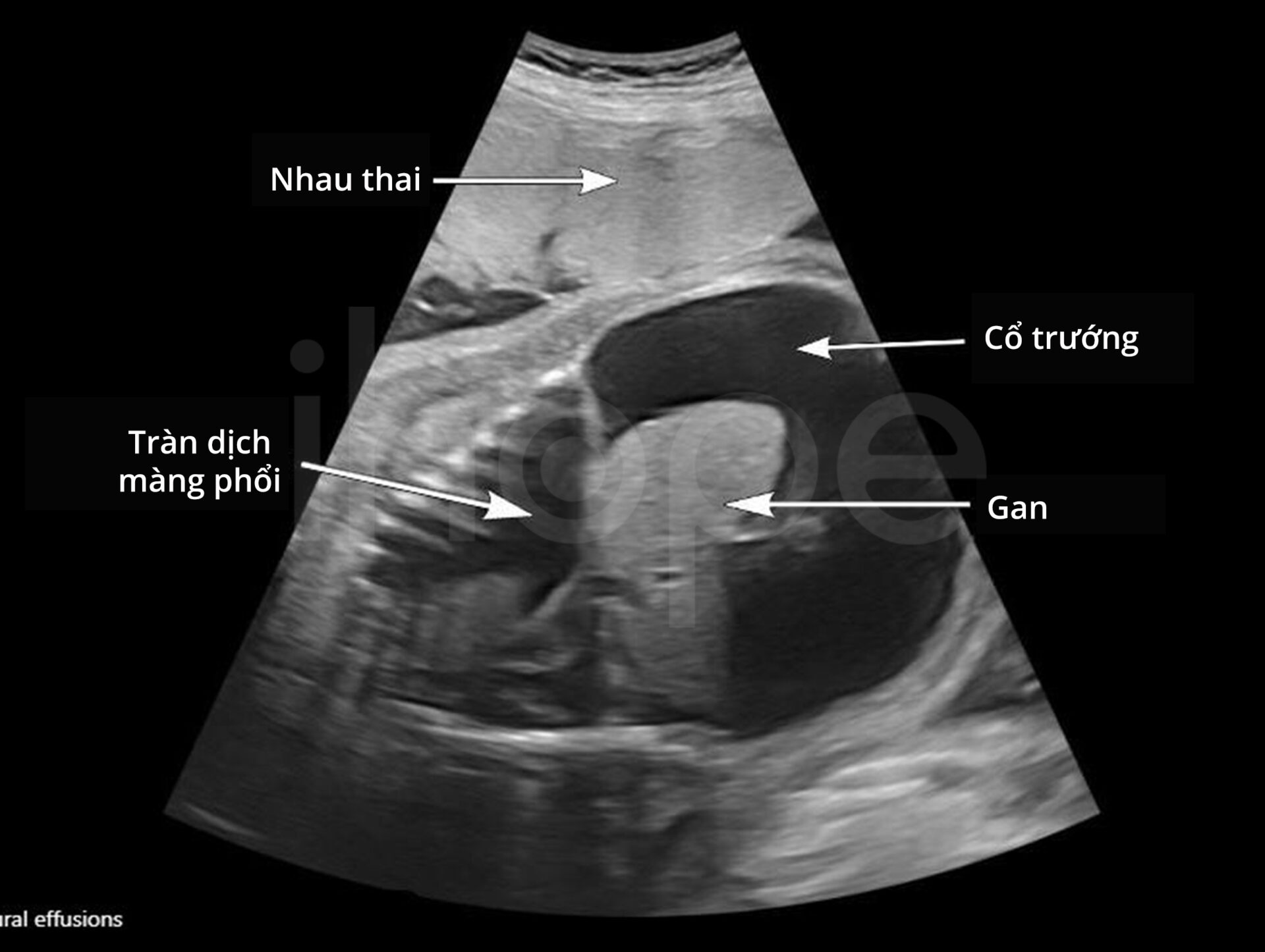 Hình ảnh siêu âm thai nhi với mặt cắt dọc ngực và bụng (1)