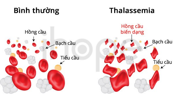Thiếu máu Thalassemia