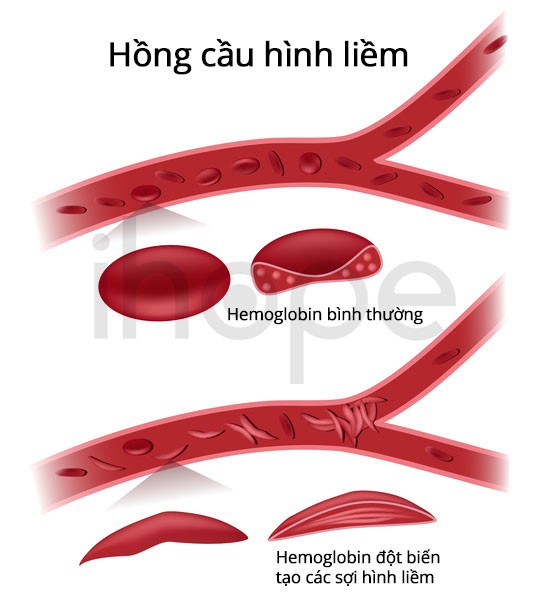 Hemoglogin đột biến tạo các sợi hình liềm