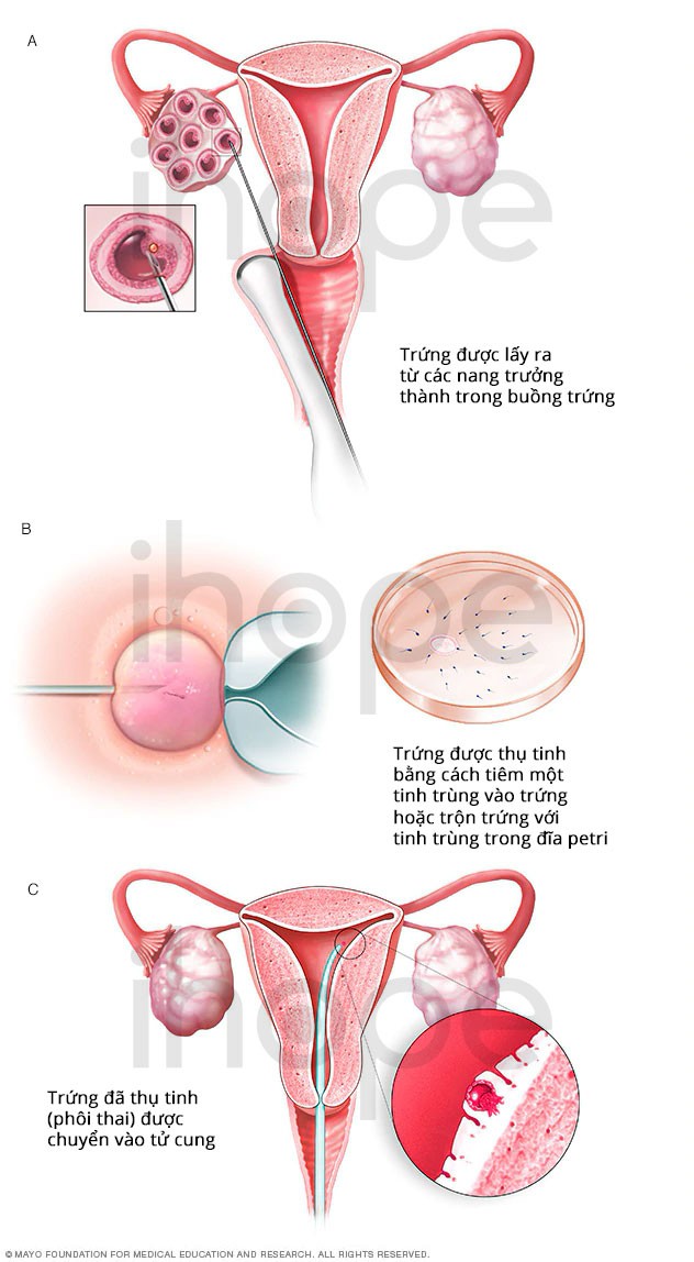 3 bước làm thụ tinh nhân tạo IVF