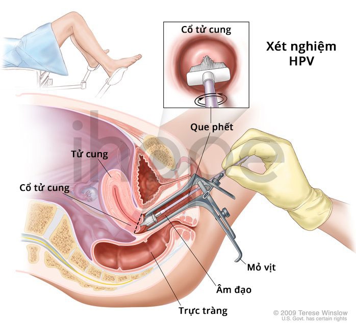 Xét nghiệm HPV bằng mẫu phết niêm mạc cổ tử cung