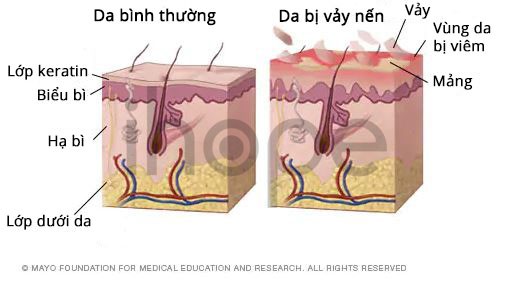 Quá Trình Phát Triển Của Bệnh Vảy Nến
