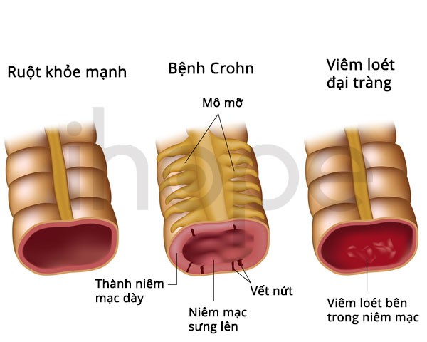 Viêm-ruột-ở-bệnh-Crohn-và-viêm-loét-đại-tràng
