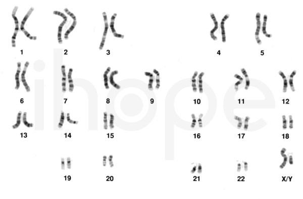 karyotype-bình-thường