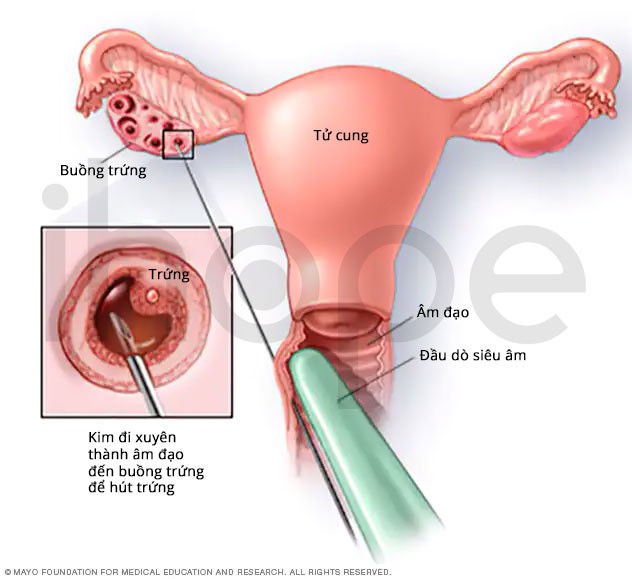 Quá trình hút trứng làm IVF