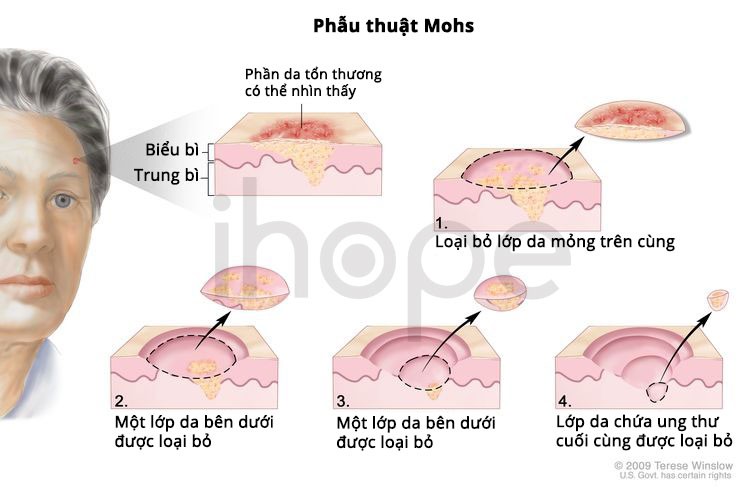 Mohs-surgery