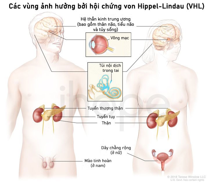 Ảnh-hưởng-của-bệnh-von-Hippel-Lindau