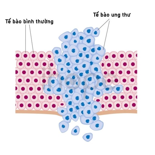 Quá Trình Phân Chia Mất Kiểm Soát Của Tế Bào Ung Thư