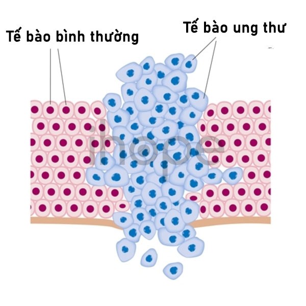 Quá Trình Phân Chia Quá Nhanh Hoặc Không Kiểm Soát Của Tế Bào Ung Thư