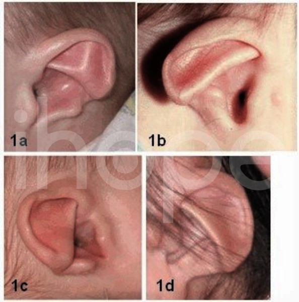 Dị dạng tai ngoài