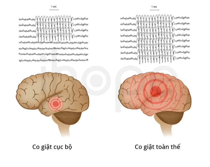 Hoạt động của não trong cơn động kinh cục bộ và cơn động kinh toàn thể