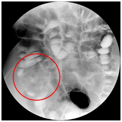 Ung thư đại trực tràng khi chụp X-quang cản quang