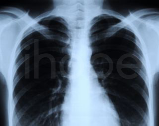 X-quang phổi