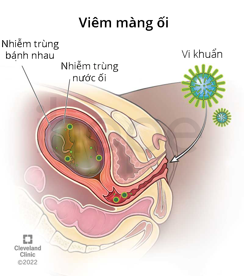Viêm màng ối