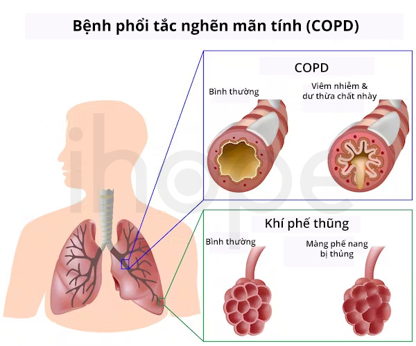 Bệnh phổi tắc nghẽn mãn tính