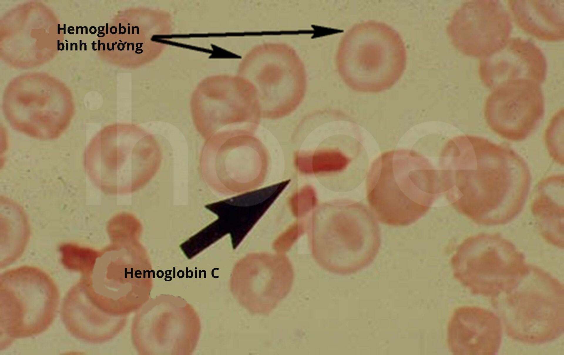 Hemoglobin C-min
