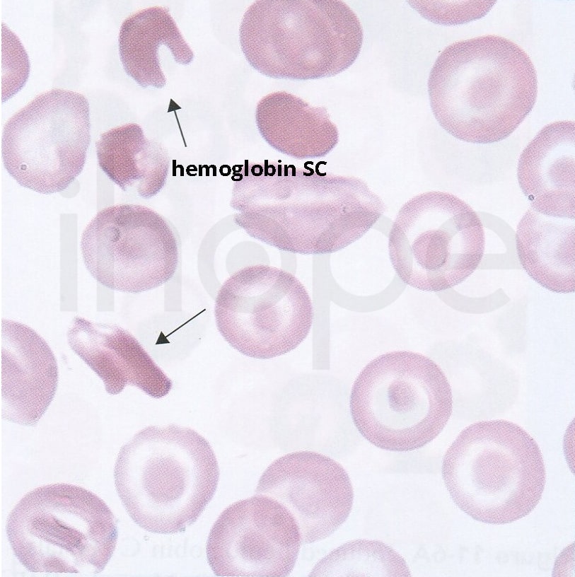 Hemoglobin SC-min