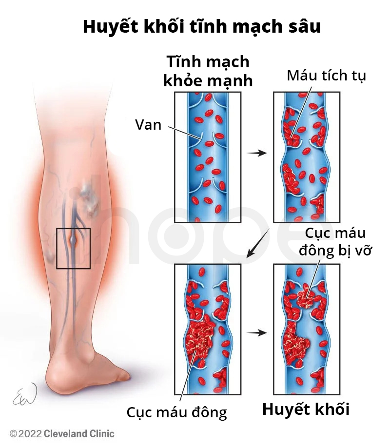 Huyết Khối Tĩnh Mạch Sâu