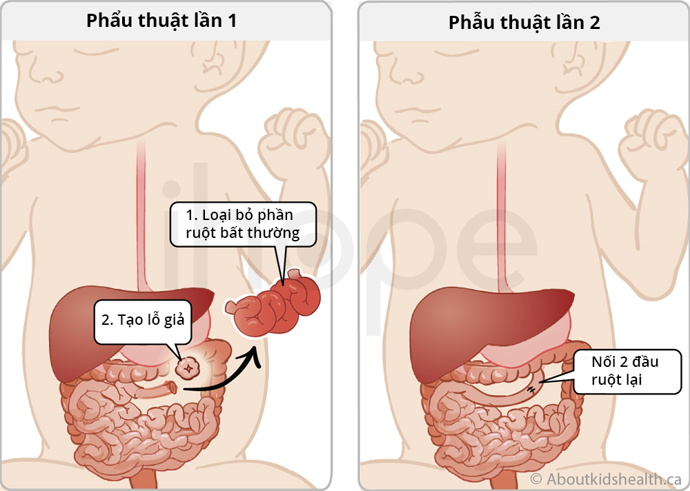 Phẫu thuật tạo lỗ giả trên da