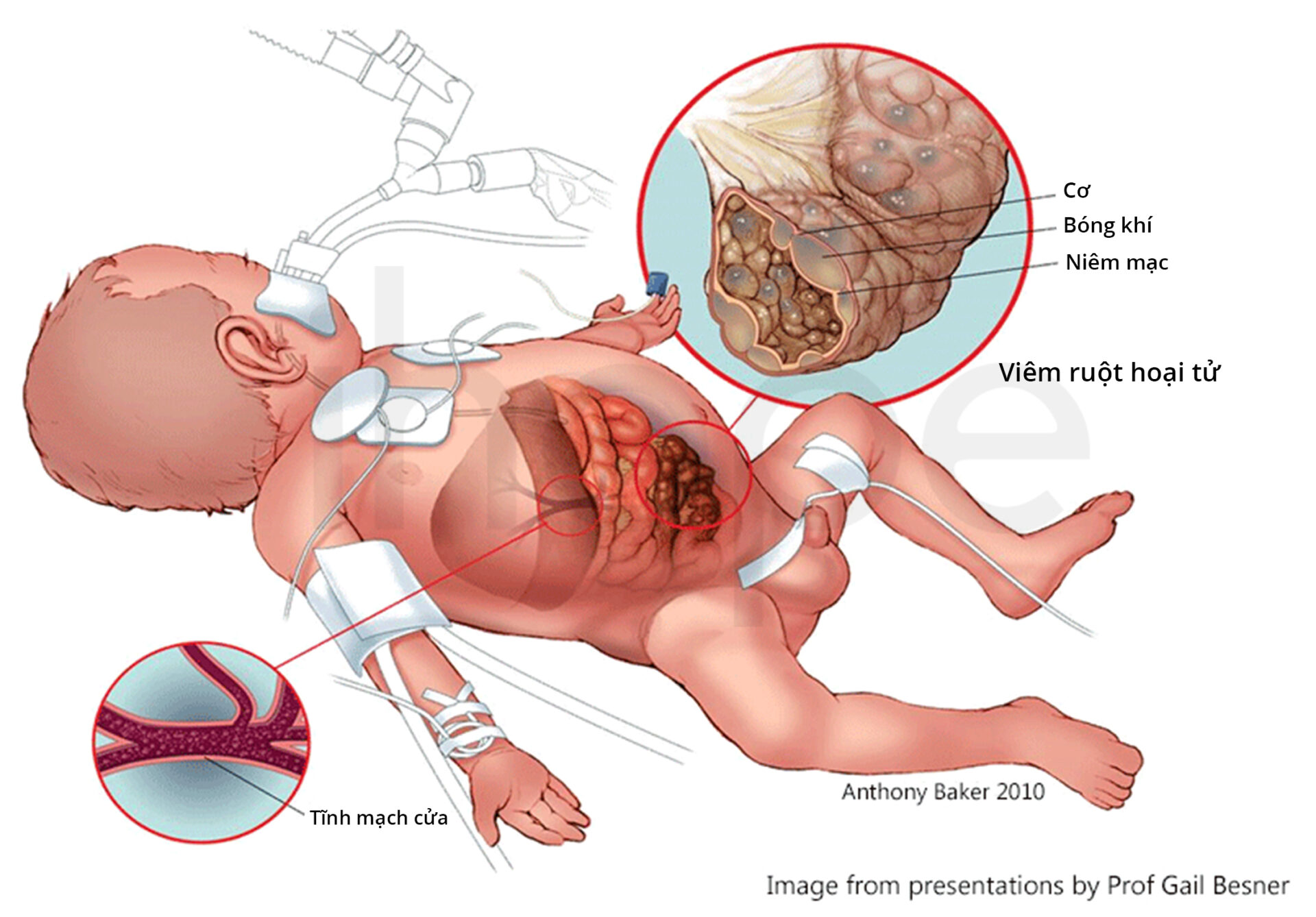 Viêm Ruột Hoại Tử ở Trẻ Sơ Sinh