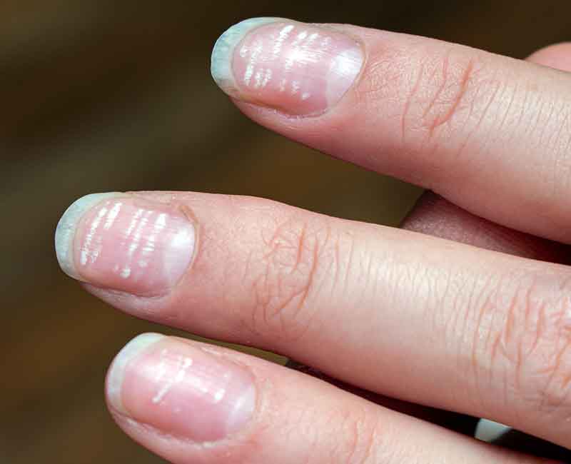 đốm Trắng Trên Móng (leukonychia)