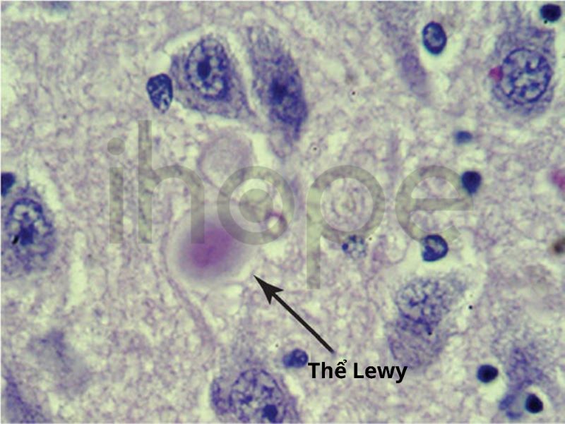 tế bào thể Lewy.
