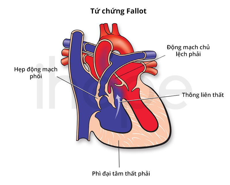 Cấu trúc tim của bệnh nhân mắc tứ chứng Fallot