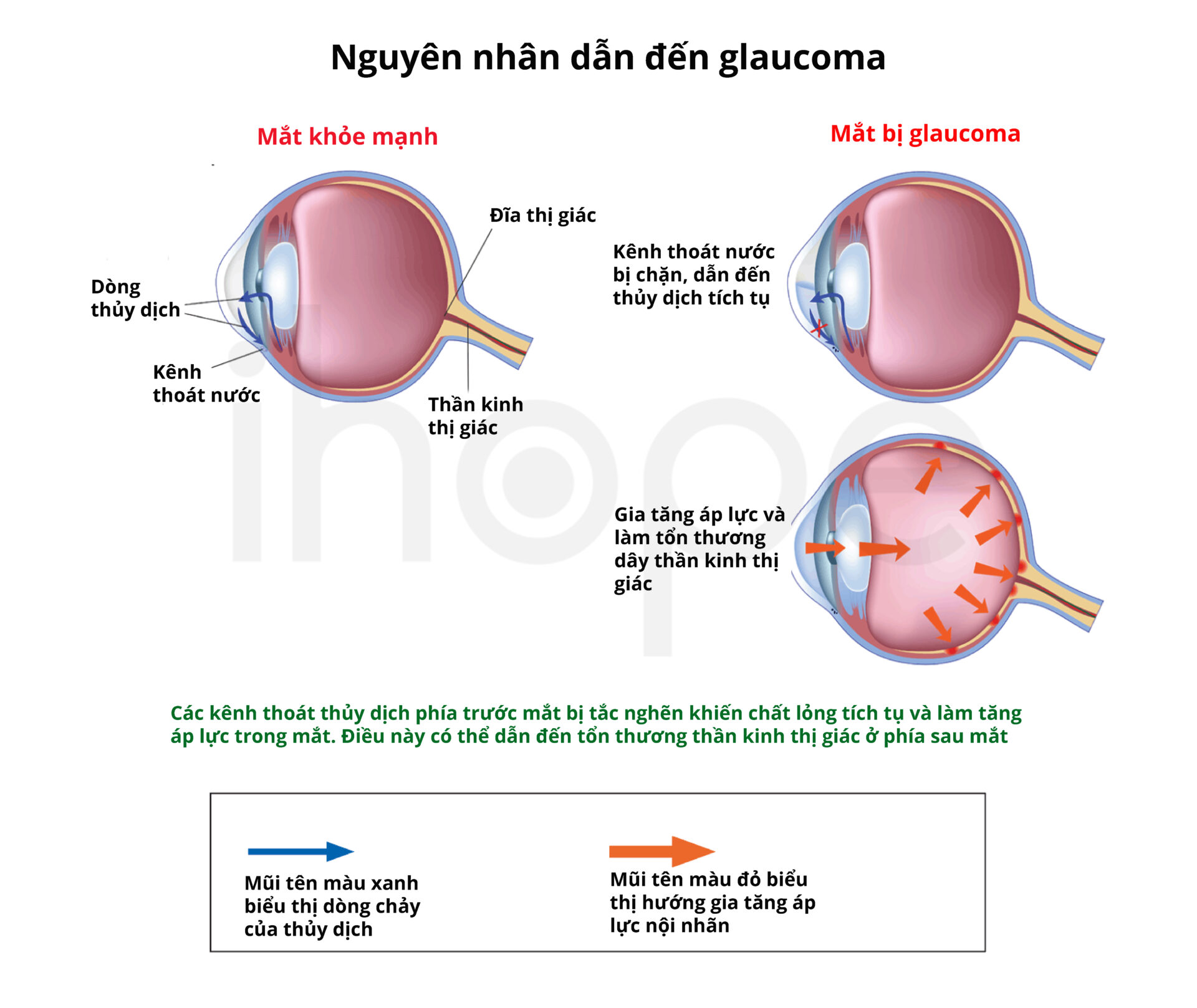 Nguyên Nhân Gây Ra Glaucoma