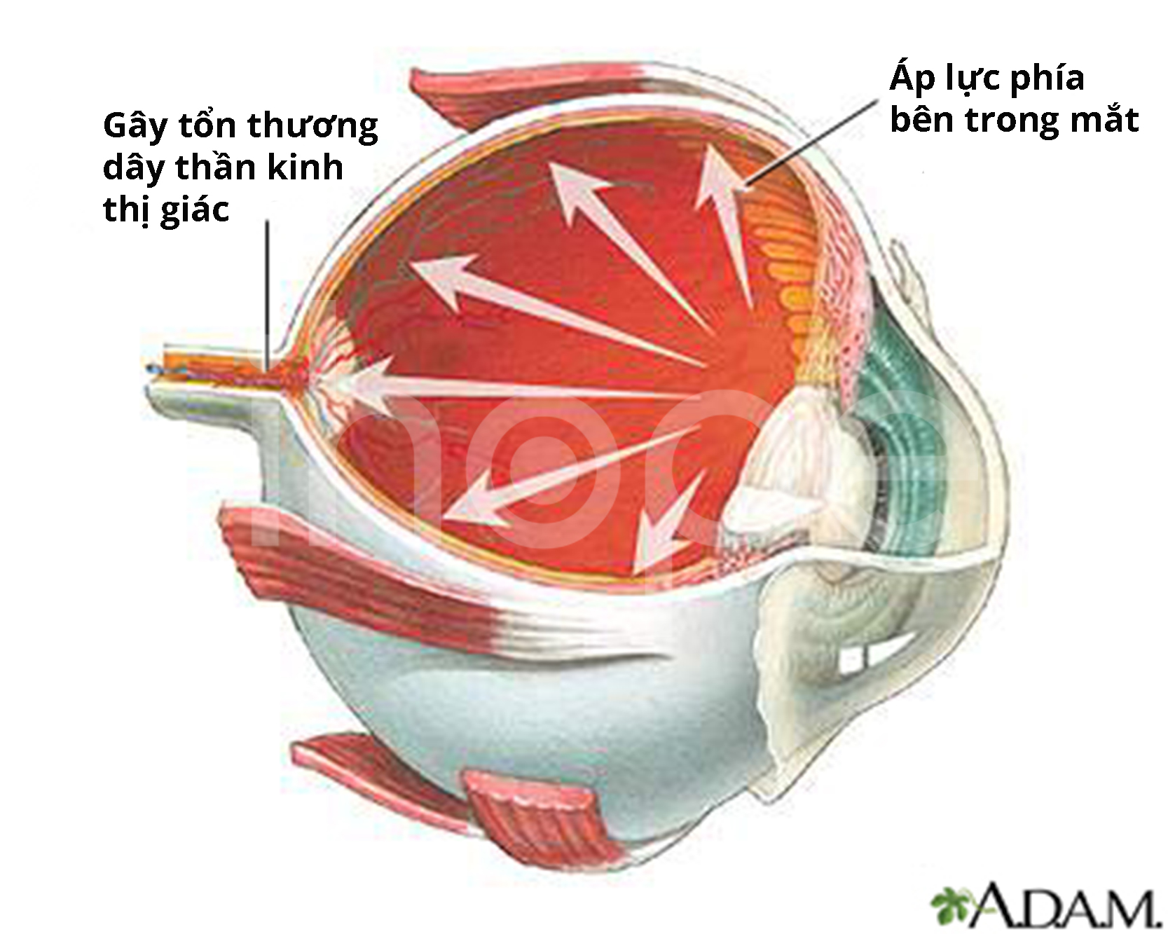 Tổn Thương Dây Thần Kinh Thị Giác