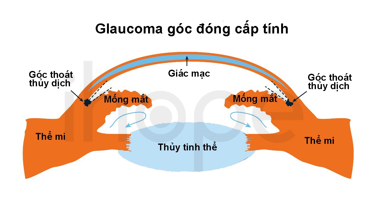 Glaucoma Góc đóng Cấp Tính