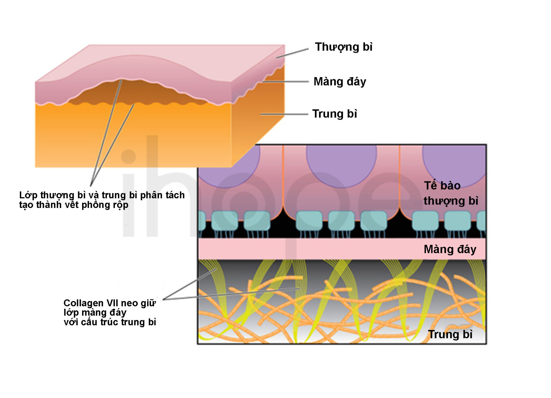 Mụn Nước Hình Thành Trong Bệnh Ly Thượng Bì Bóng Nước