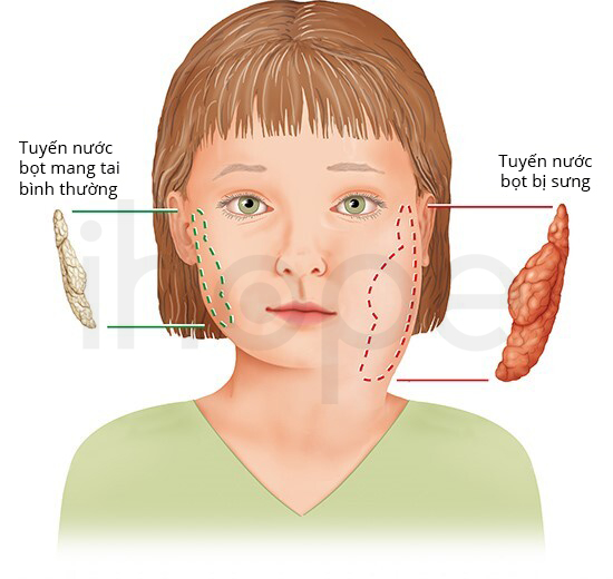 Sưng Tuyến Nước Bọt