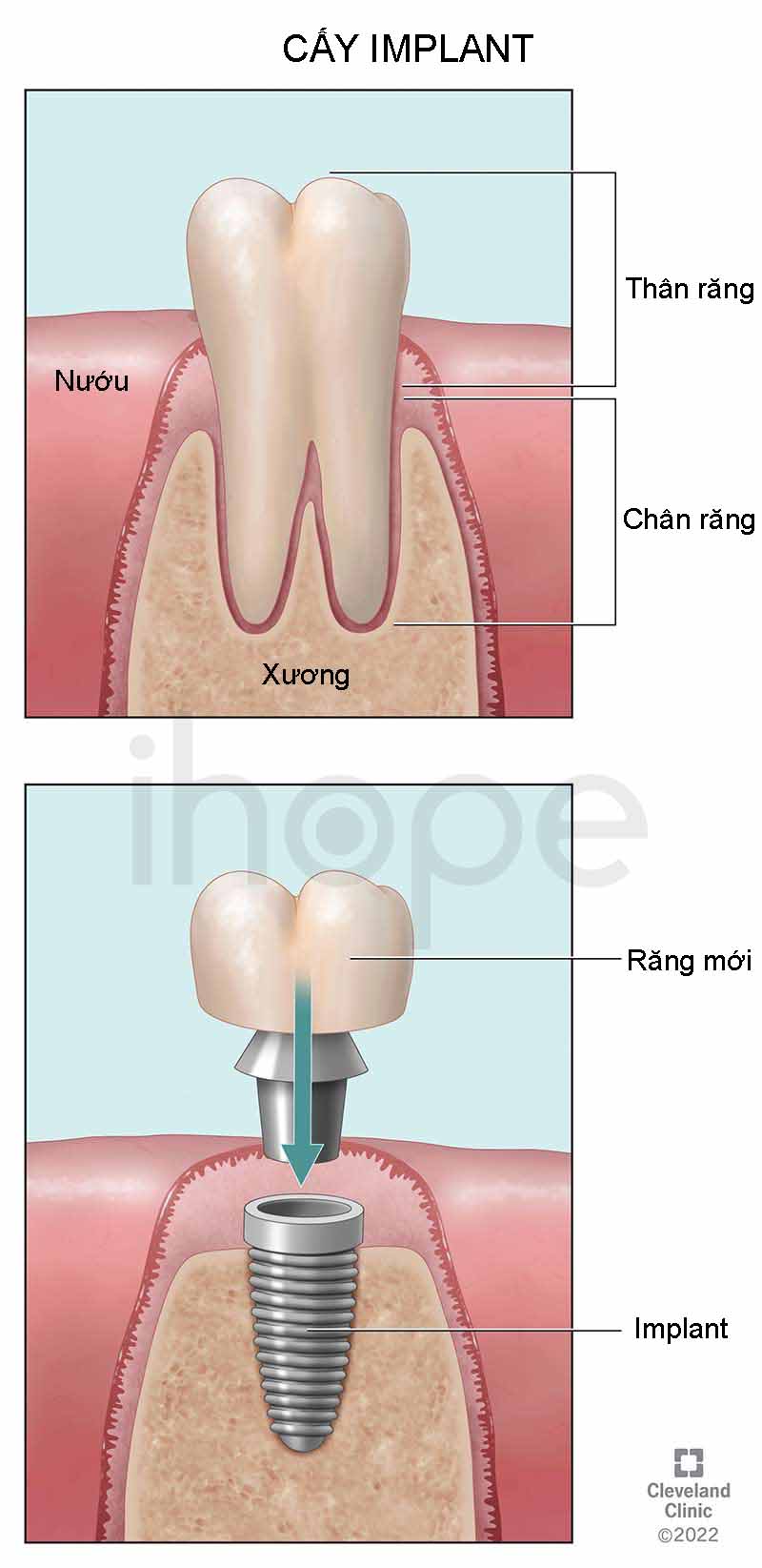 Cấy Implant