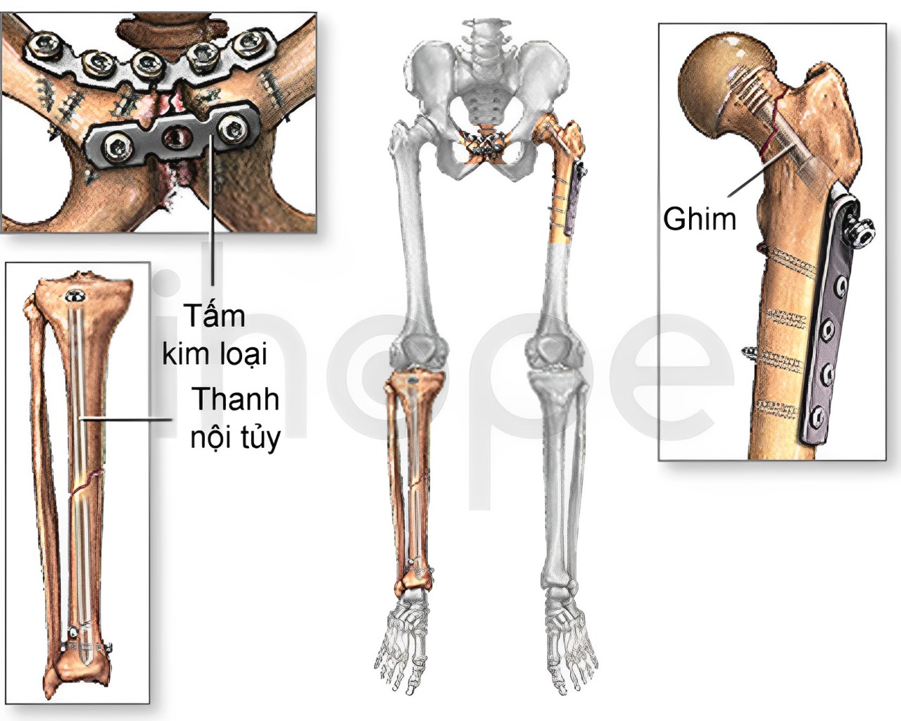 Cố định Xương Ghép Bằng Vít, Thanh Kim Loại (1)