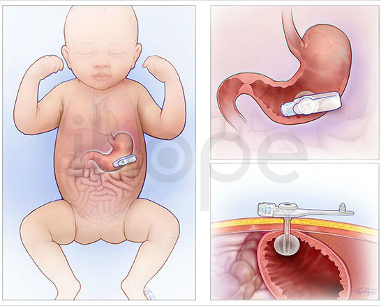 đặt ống Dẫn Thức ăn