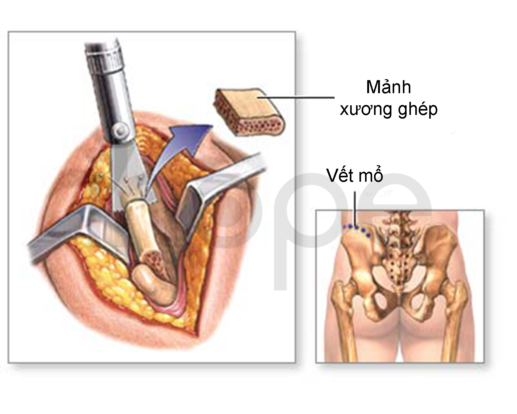 Ghép Xương Tự Thân
