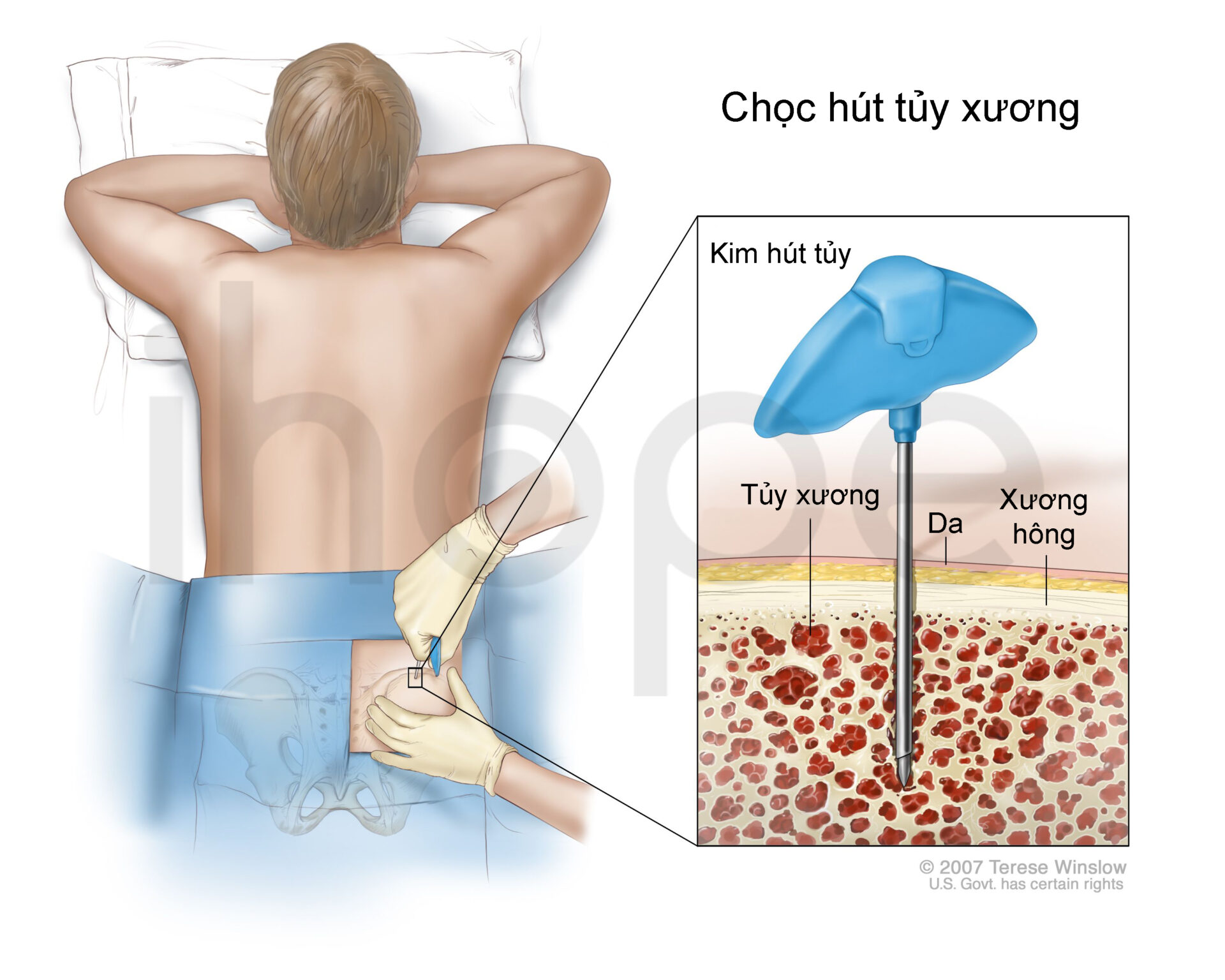 Hút Tủy Xương