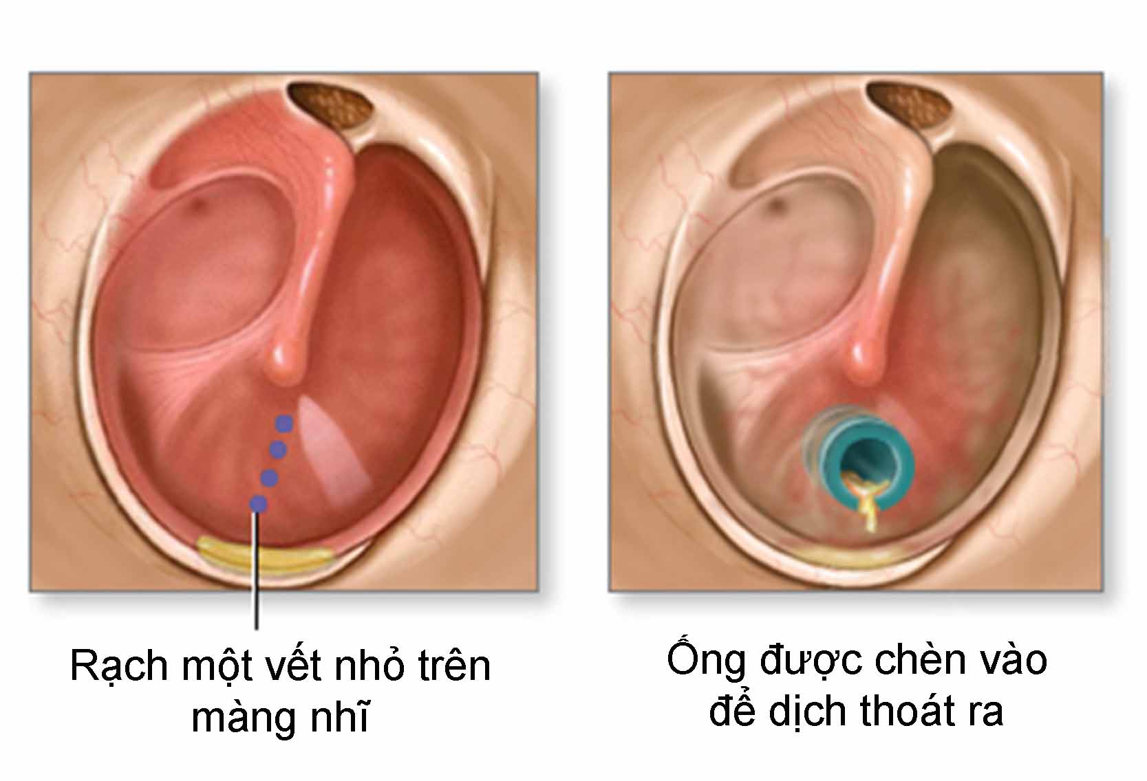 Kĩ Thuật đặt ống Trong Tai