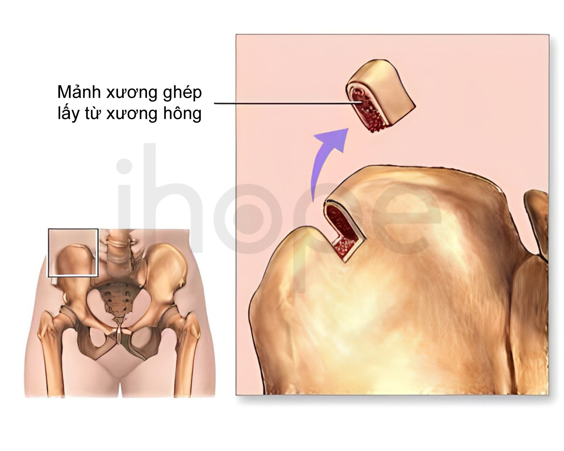 Phẫu Thuật Lấy Xương (1)