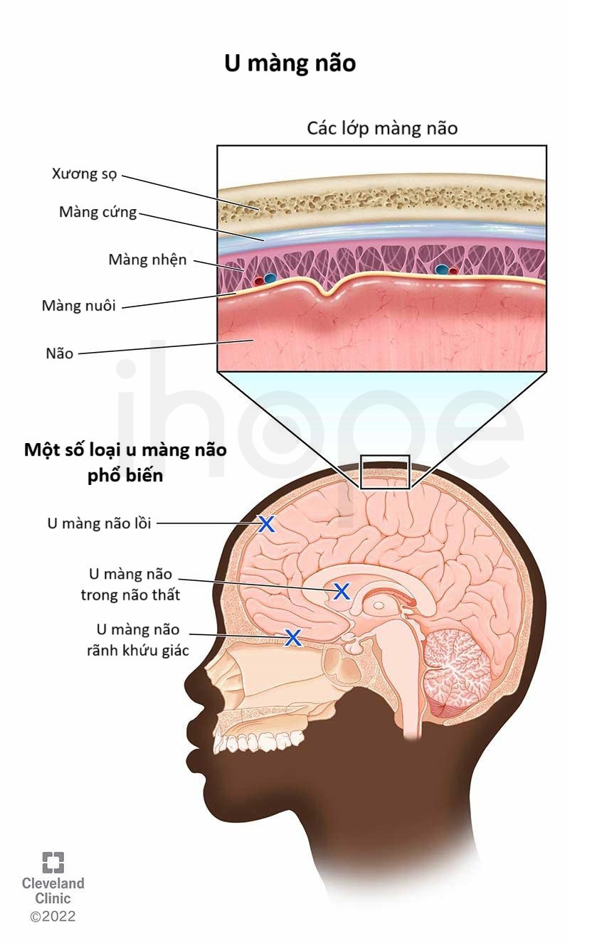 Các Lớp Màng Não Và Một Số Loại U Màng Não Phổ Biến