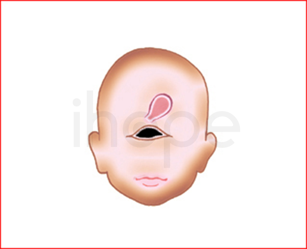 Dị Tật Một Mắt Và Mũi Hình ống
