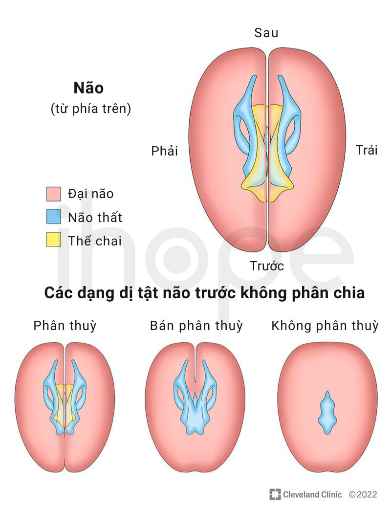 Dị Tật Não Trước Không Phân Chia 1