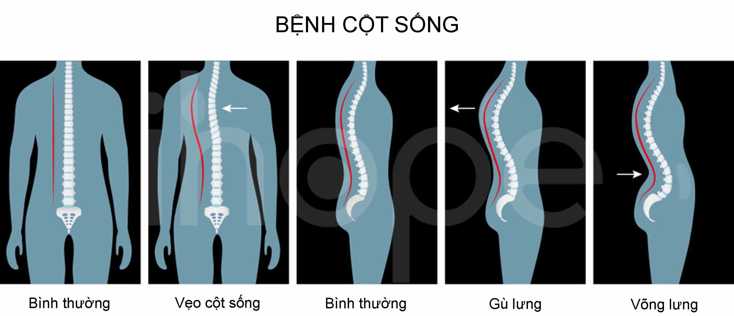Gù Lưng Và Vẹo Cột Sống