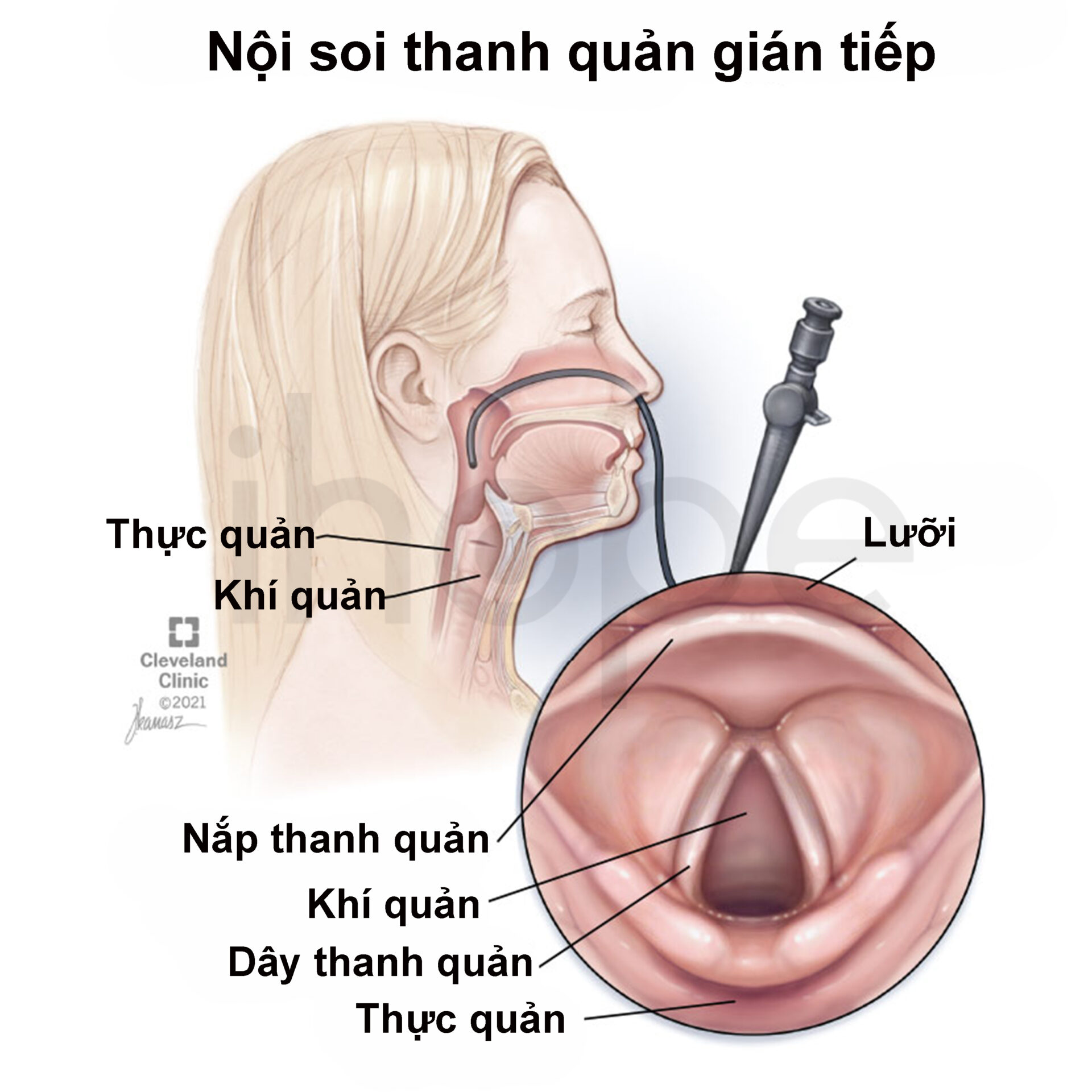 Nội Soi Thanh Quản Gián Tiếp