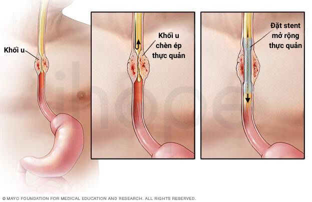 Stent Thực Quản 1
