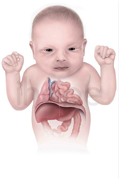 Thoát Vị Cơ Hoành