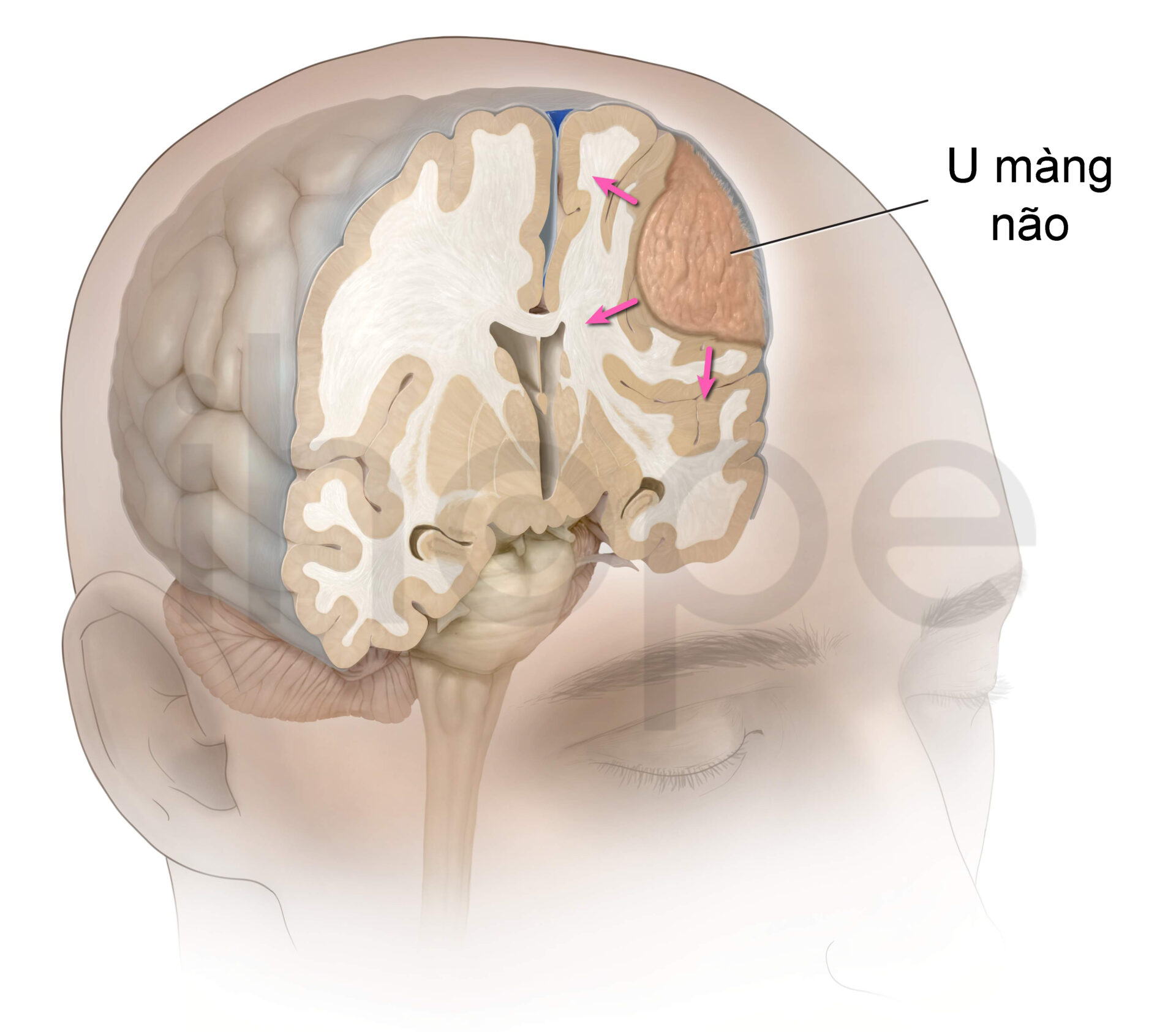 U Màng Não