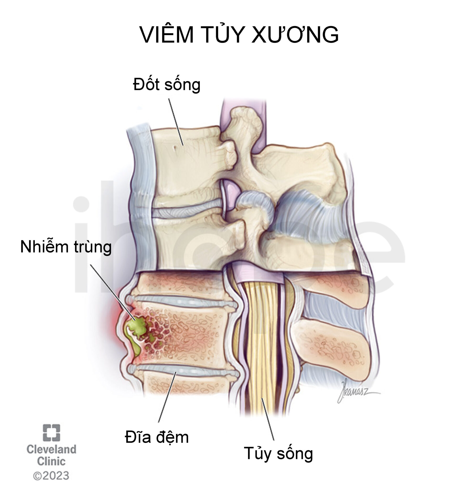 Viêm Tủy Xương