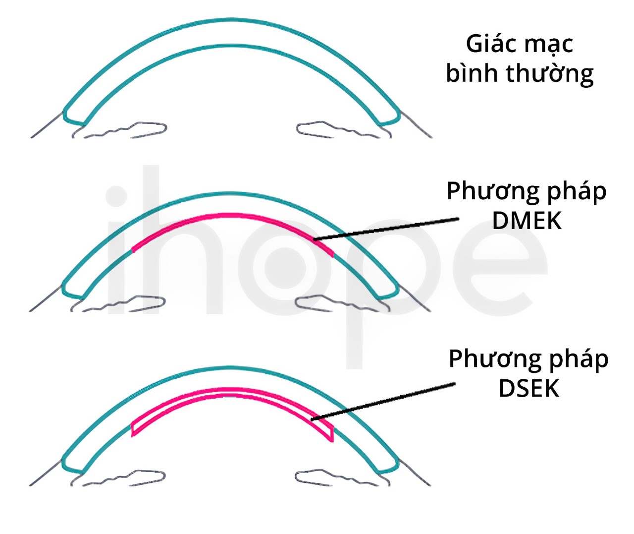 Phẫu Thuật Giác Mạc